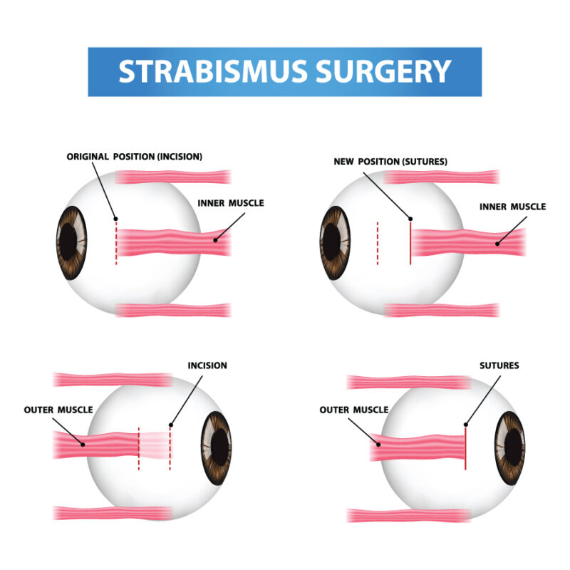 Diagram of eye muscle adjustment during strabismus surgery